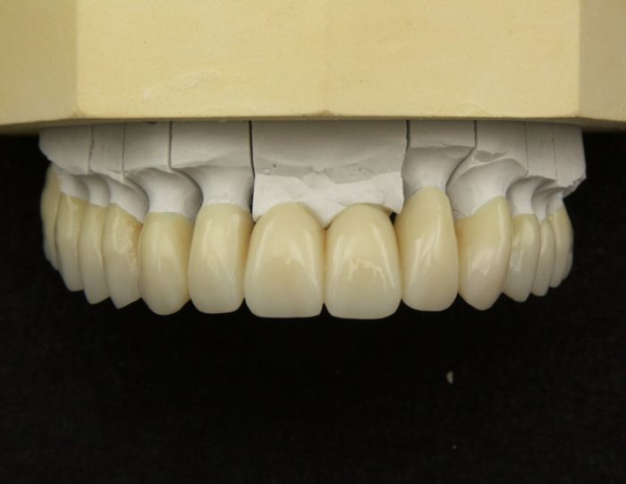 Réalisations mixtes Dental Art Technology couronne dentaire implantaire zircone céramo métal